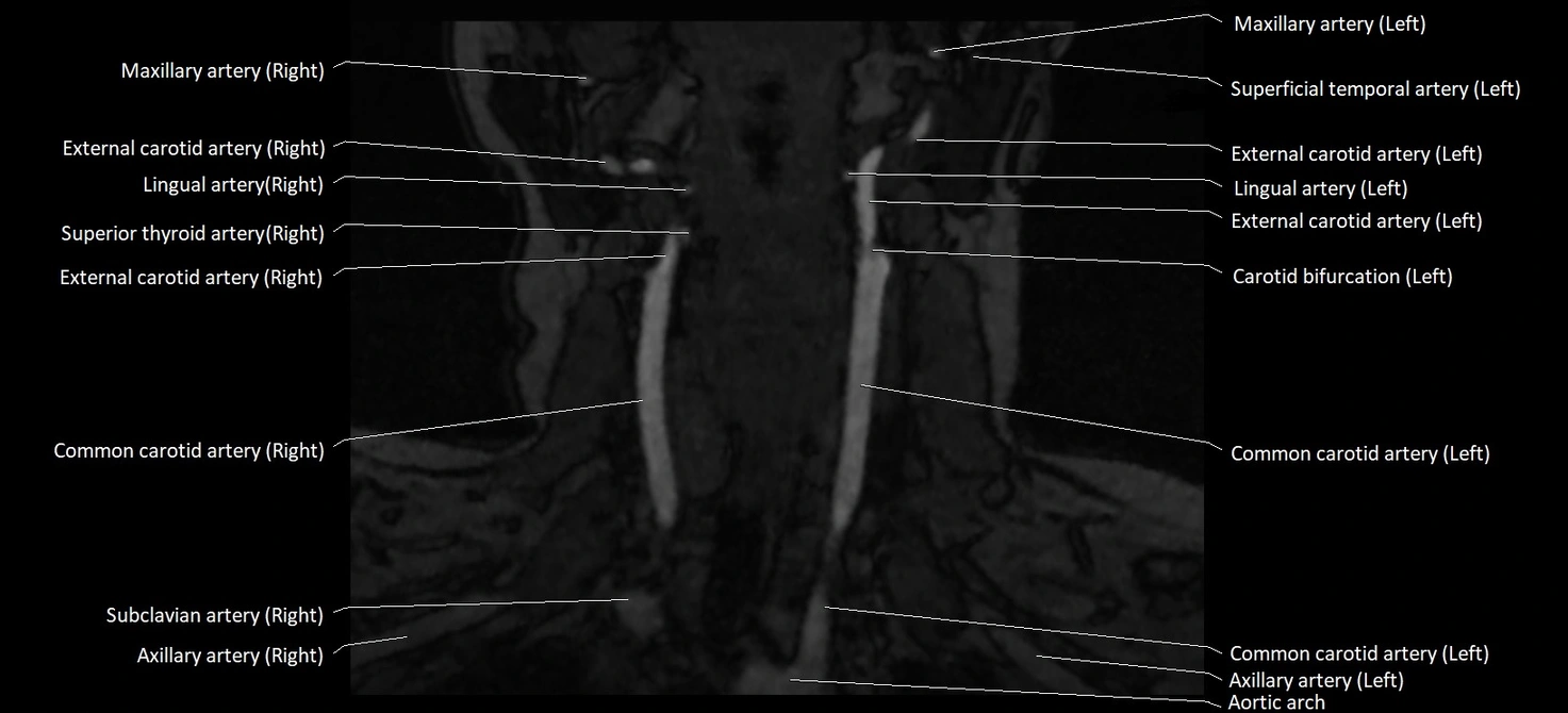 MRA carotid artery anatomy cross sectional 3T coronal image 5.webp